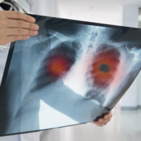 Lung Cancer: Symptoms, Stages & Treatment