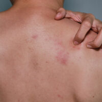 【生蛇】详解带状疱疹成因、症状及传染风险