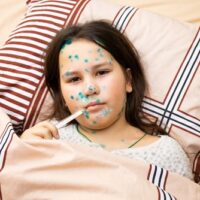 【水痘】几天会好? 了解症状、治疗及如何预防传染