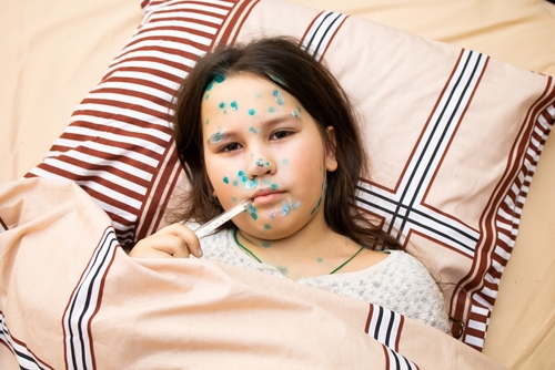 【水痘】几天会好? 了解症状、治疗及如何预防传染