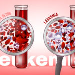Leukemia: Mga Sintomas, Sanhi at Paggamot