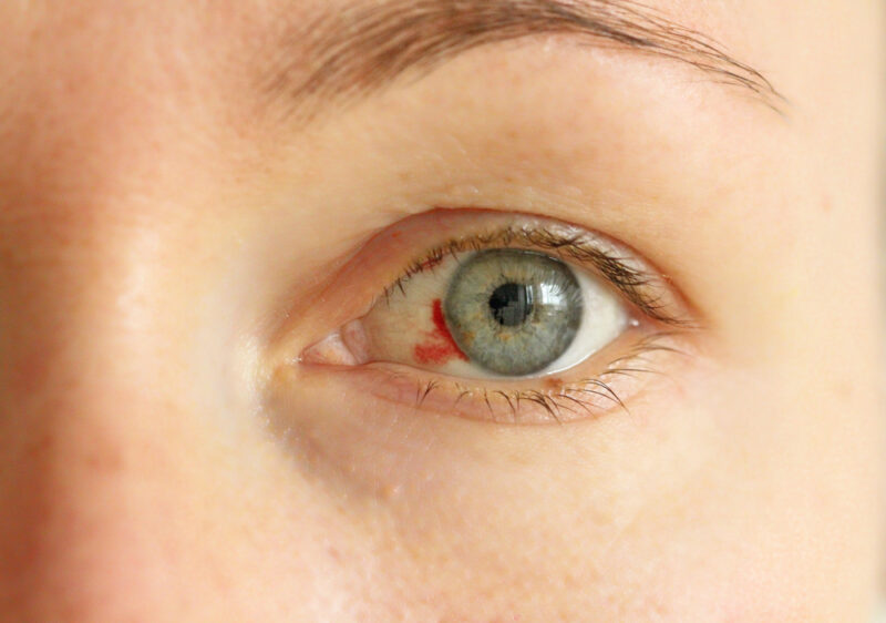 Vết máu trong mắt là triệu chứng tăng huyết áp