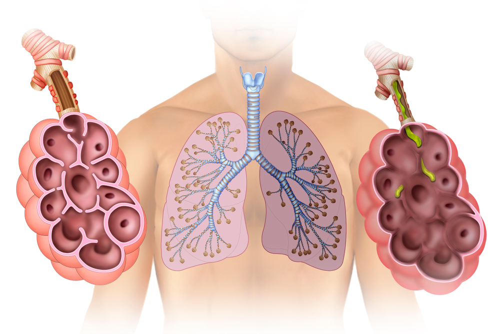 Khí phế thũng: Bệnh phổi mạn tính bạn chớ xem thường